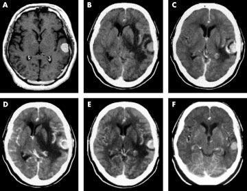 228 Chang, Chang, Choi, et al Complications Complications after GKS for meningiomas were found in 35 lesions (25.0%) among the 140 lesions followed up with MRI.