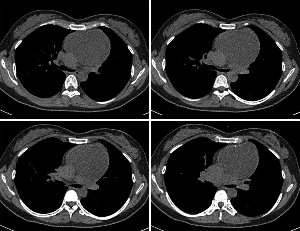 Journal of Thoracic Disease, Vol 6, No 6 Jun 2014 E101 Figure 2 Chest computed tomography scans show an anterior mediastinal mass causing extrinsic compression of the brachiocephalic vein to the