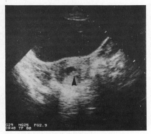 The single false-negative was a bicornuate uterus with a rudimentary left horn that appeared normal on ultrasound examination.