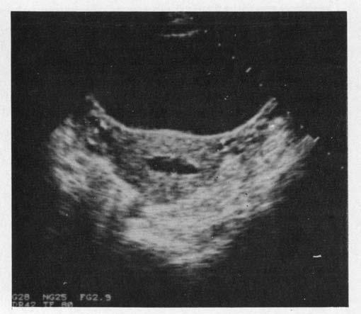No significant uterine synechiae were encountered in the patients studied.