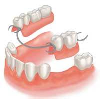 Dentures in the upper jaw are typically able to obtain retention by creating suction much like a suction cup. This is not available in the lower jaw due to the nature of the lower jaw bone.