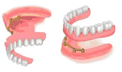 Occasionally, denture wearers may use adhesives. Adhesives come in many forms: creams, powders, pads/wafers, strips or liquids.