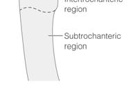 regions Intracapsular Extracapsular Pain, shortening, and external rotation of the affected lower extremity Figure 42-8.