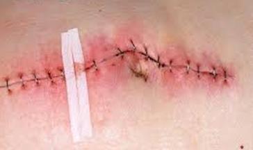 Post operative 1. Post operative incision care 2. Education of patient & relatives on wound care Pola Brenner, et al.