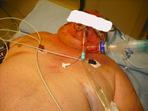 Contraindications Relative Coagulopathy in an UNSTABLE patient Cellulitis over insertion site Inability to tolerate pneumothorax Peripheral access adequate