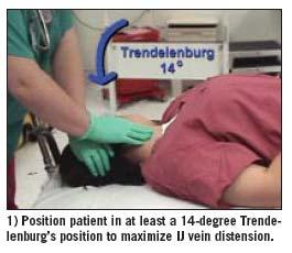 Tip # 4 Patient Position Vaslsalva may maximize size Difficult to coordinate Position the patient at a 14- degree Trendelenburg