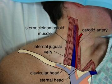 Internal Jugular Runs with the Carotid Typically anterolateral Can be found at the apex