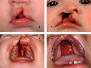 Ectodermal Dysplasia, and cleft lip/palate)