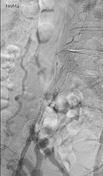 stenting using conventional