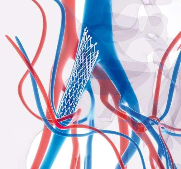 Dedicated May-Thurner Stent: