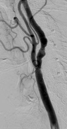 efficacy of GORE Carotid Stent in patients at increased risk for