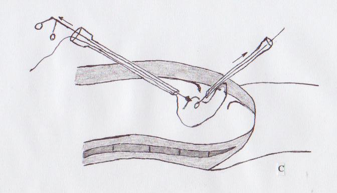 Figure 1C: The prolene end was detached from the loop and hold by laparoscopic forceps. Then, the forceps was withdrawn to bring the prolene end outside the abdomen through the working port.