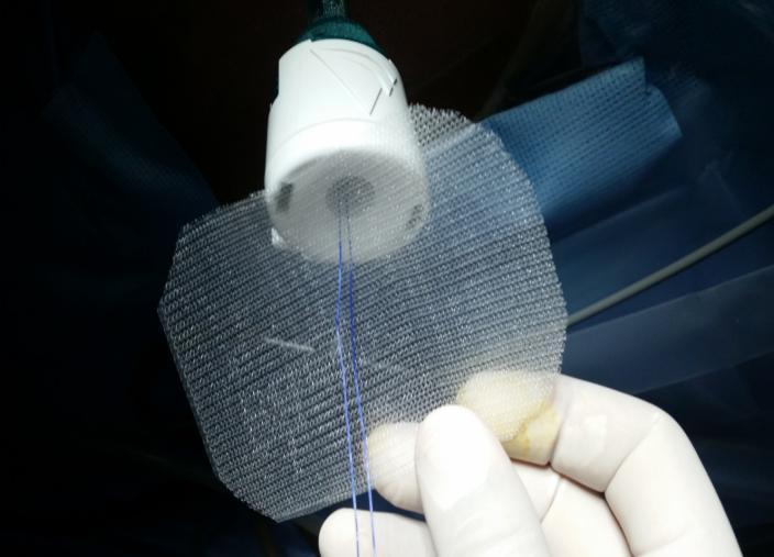 the mesh in both self-fixation mesh and mesh fixed by tissue glue 12,24.