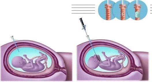 Prenatal intervention in CDH Deprest J Pediatr Surg 2006;