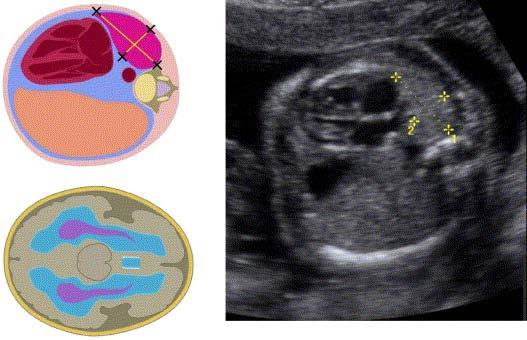 The lung to head ratio (LHR) in prenatal prediction