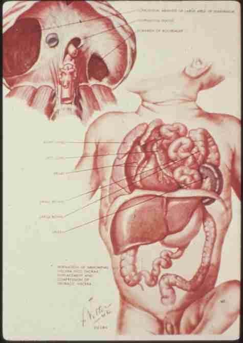 Congenital Diaphragmatic Hernia 1960-80 A