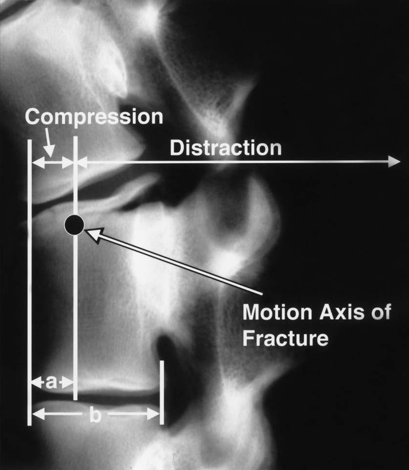 The motion axis of fracture (MAF) (4) is defined as the transitional point from anterior compressive to posterior splitting failure, as seen on the lateral radiograph.