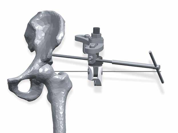 Distal Bone Screw Insertion Using the fixator as a template, insert two to three soft tissue guides (PN-03085)
