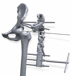 The femur should be positioned while applying the distal bone screws in the same abduction as the perpendicular