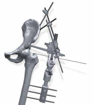 Necessary Outriggers Supplemental bone screw fixation is strongly recommended due to the immense torsional