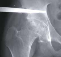 The use of fluoroscopy is imperative to assure that over-penetration in not achieved (fluoroscopic Judet views can be utilized to confirm placement).