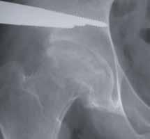 Placement of the proximal bone screws is in the superoacetabular region, and these are placed approximately 2 cm above the joint.
