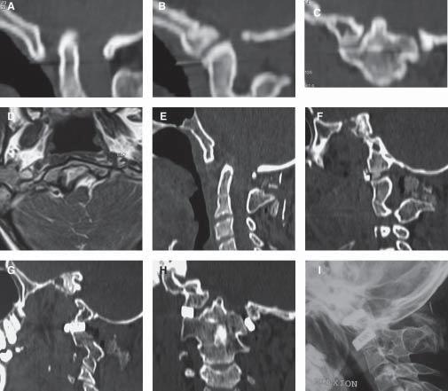 Figure 1: Images of a 17-year-old male patient. (A) Preoperative CT scan shows basilar invagination. Assimilation of the atlas can be observed.