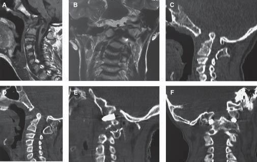 Figure 2: Images of an 11-year-old male patient. (A) Preoperative MRI showing basilar invagination (transoral surgery was already attempted) and cord changes.