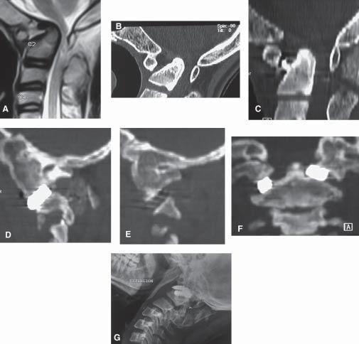 Figure 3: Images of a 15-year old female. (A) Preoperative MRI showing basilar invagination and Þxed atlantoaxial dislocation.