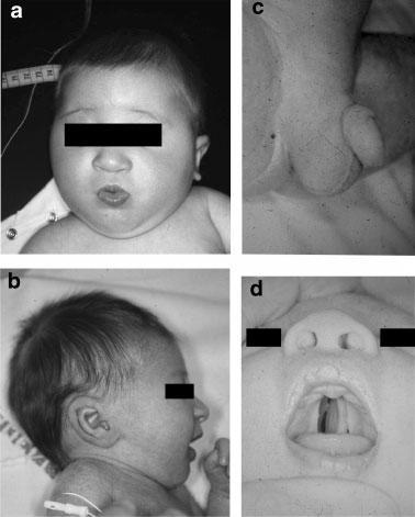 5. BMRS, V (Verloes) Type distinctive anomalies such as: severe microcephaly, severe epilepsy,