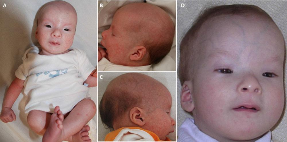 Patient 2 2mths: thin sparse hair/eyebrows, frontal prominence,