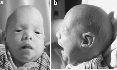 4. BIDS, MKB (Maat Kievit Brunner) Type in contrast to the others, is characterized by X-linked inheritance and facial coarsening at older age: triangular face and the