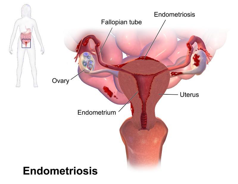 Figure 01: Endometriosis Symptoms of Endometriosis Congestive dysmenorrhea Ovulation pain Deep dyspareunia Chronic pelvic pain Lower sacral backache Acute abdominal pain Subfertility Menstrual