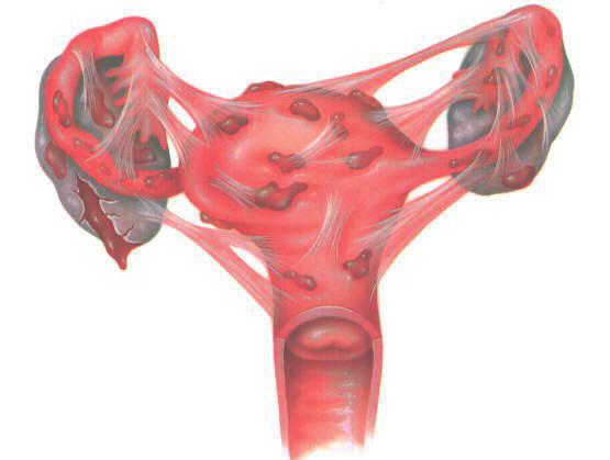 What symptoms and problems does endometriosis cause? Bleeding internally into the pelvis and abdominal cavity leads to inflammation and scar tissue formation.