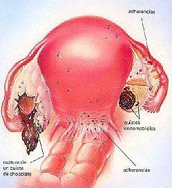 But when a woman develops endometriosis, microscopic bits of this tissue escape from the uterus and grow on other organs such as the ovaries, the outer wall of the uterus, the ligaments that support