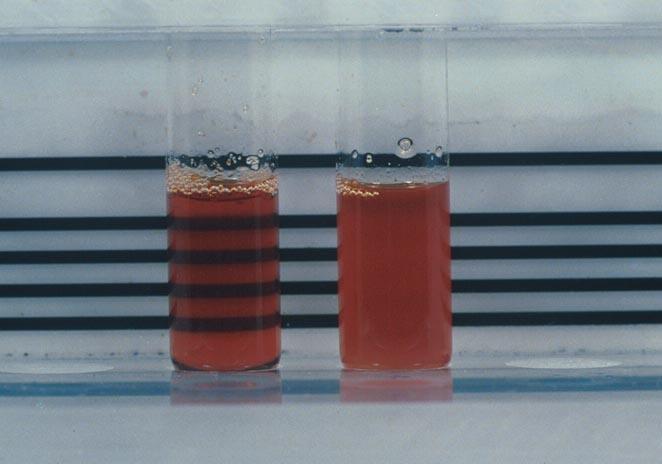 Solubility test (Sickledex): Test to identify HbS. HbS is relatively insoluble compared to other Hemoglobins.
