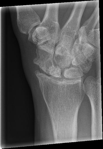 Occult Scaphoid Fracture Most commonly fractured carpal bone Typically young men Delay in diagnosis Nonunion
