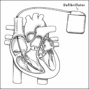 Implantable Cardioverter - Defibrillators Cardioversion - applying electrical shock to change an abnormal heartbeat into a