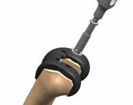 Attach the Housing Resection Collet to the femoral trial. Note: Speed pins are contraindicated for use with the FastPak femoral trial.