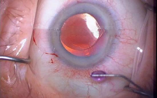SINGLE USE CANNULAS PATHOGEN FREE OUTCOMES RETAINED TRYPAN BLUE IN CANNULA FROM CASE 3 DAYS BEFORE! http://webeye.ophth.uiowa.edu/eyeforum/cases-i/case85/ tass-vid.