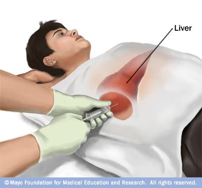 Liver biopsy» Used for grading and staging of liver disease but also necessary for diagnosing other liver conditions (Autoimmune hepatitis, Wilsons, Liver steatosis)» Typically interventional