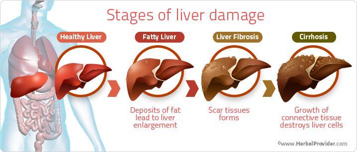 Inflammation HCV infection causes inflammation of the liver Over years, inflammation leads to scarring (scarring = fibrosis) Severe scarring (F4=stage 4 fibrosis or