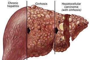 Chronic* HCV Infection 75-85% develop chronic infection and may remain stable for years o 20%-30% develop cirrhosis