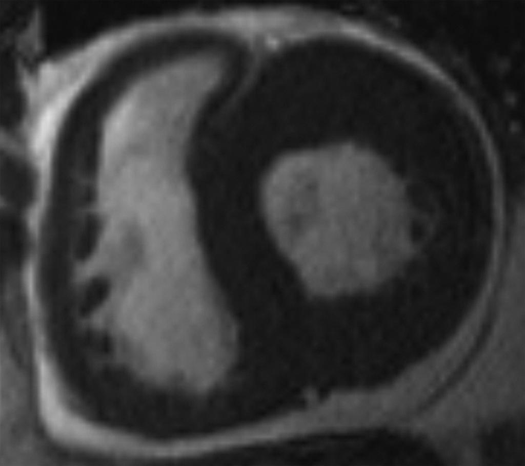 Cardiac Amyloidosis Amyloid proteins are abnormally deposited within heart, especially myocardium Nobody famous L Imaging findings: LV