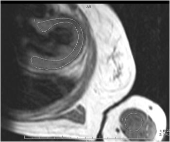 Myocarditis 3- plane loc, axial haste Cine bright blood (SSFP) 2C, SA, 4C Evaluate cardiac function usually reduced T2- weighted images SA and 4C Myocardial