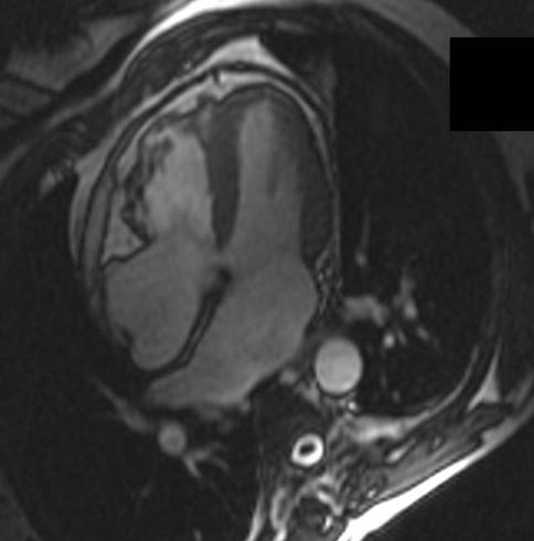 ARVC 3 plane loc, axial haste Fibrofatty inﬁltration of the right