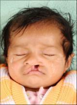 CASE REPORT 4 A 9 day old female patient with complete unilateral cleft lip and palate was referred from Plastic Surgery Department to our department with negative systemic and family