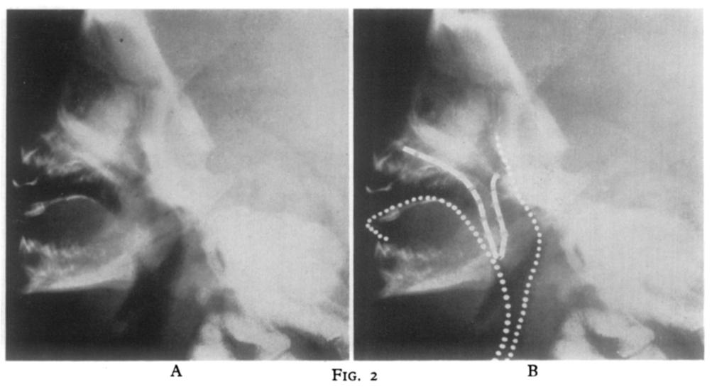 TREATMENT OF CLEFT PALATE ASSOCIATED WITH MICROGNATHIA 285 allows the tongue to rest against the soft palate and prevents it from completely obstructing the airway. Fig. I.