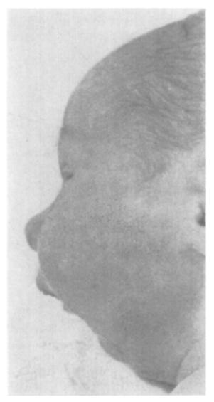 Note tongue filling hypopharynx and also the nasopharynx through the palate cleft. FIG. 3 A FIG. 4 B the palate repair might be helpful.