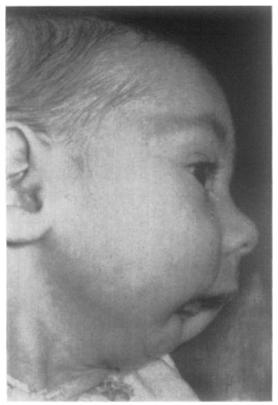 Note position of tongue and soft palate and development of mandible. FIG. 5 A FIG.